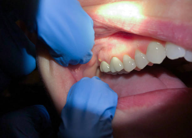 Best Emergency Tooth Extraction in Burns Harbor, IN